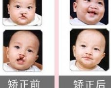 吃兔肉真的會(huì)長兔唇？為什么會(huì)長兔唇？